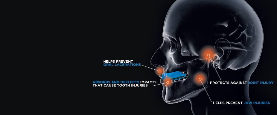 The importance of using a mouthguard in sport training